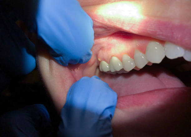 Best Emergency Gum Treatment in Barnesville, GA